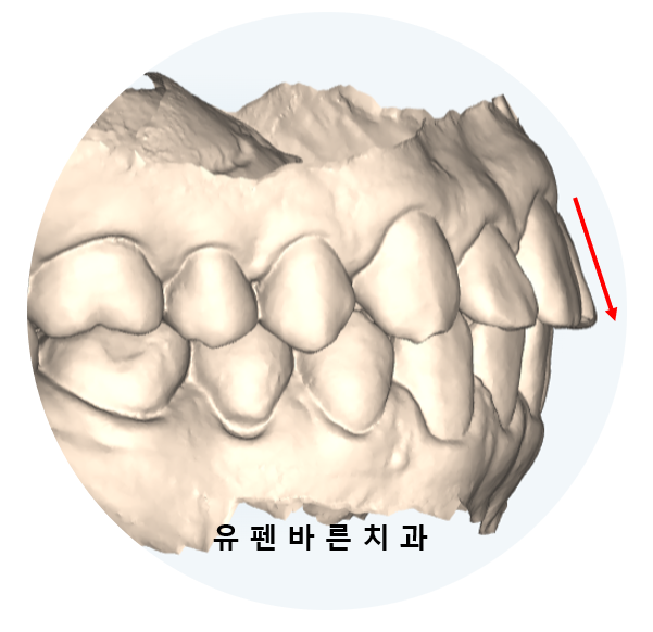 예전에 교정했는데 앞니가 뻐드러져서 컴플렉스에요! ( 비발치교정 인비절라인으로 재교정 해볼까요?) 관련 이미지 2