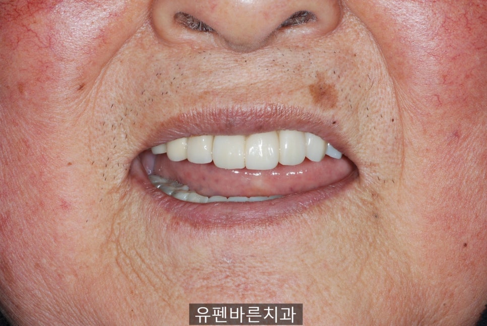 연세가 엄청 많으신데도 전체 임플란트 수술이 가능하다구요? 관련 이미지 7