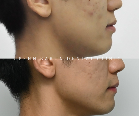 주걱턱 반대교합도 잠실인비절라인 잠실교정치과 유펜바른치과에서!(비발치주걱턱교정 잠실성인교정 반대교합인비절라인 잠실교정치과 주걱턱교정후기) 관련 이미지 5