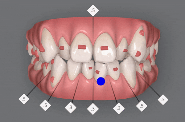 잠실덧니교정 인비절라인으로 컴플렉스 해결! (비발치교정 인비절라인등급 인비절라인후기 ) 관련 이미지 2