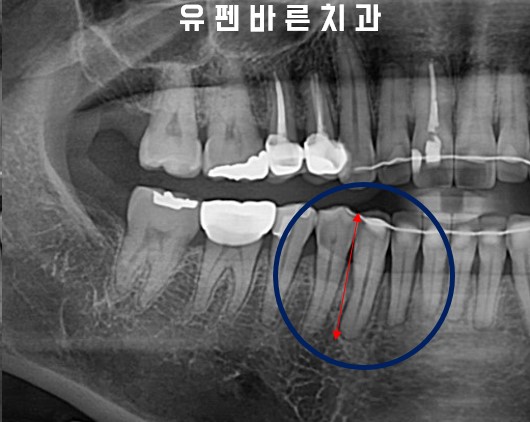 앞니부분교정 잠실인비절라인 라이트 옵션 들어보셨나요? 관련 이미지 10