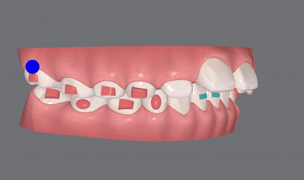 저도 친구들이 많이 하는 인비절라인교정 하고싶어요! 관련 이미지 8