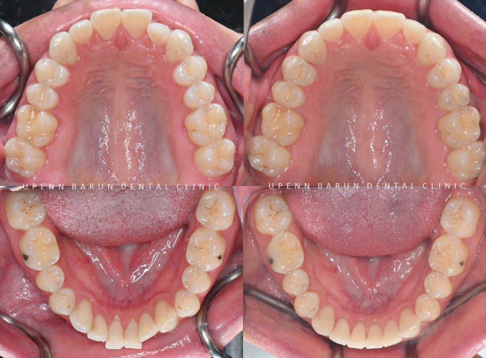 인비절라인을 시작할때 고려해야 하는 세가지 조건 (인비절라인다이아몬드 다이아몬드등급치과 인비절라인앞니교정 앞니급속교정 비발치교정 치간삭제 치간삭제양) 관련 이미지 15