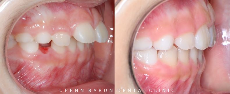 유독 튀어나와 다치기 쉬운 앞니! INVISALIGN FIRST로 8개월만에 끝낸 후기 (송파인비절라인소아교정 인비절라인1차교정 송파인비절라인퍼스트  송파인비절라인어린이교정) 관련 이미지 14