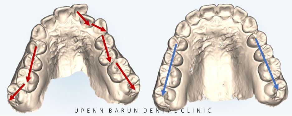'웃을때 입을 자꾸 가려요'  활짝 웃은 중학생 비발치 인비절라인후기 (잠실새내인비절라인 청소년인비절라인 잠실교정치과) 관련 이미지 6