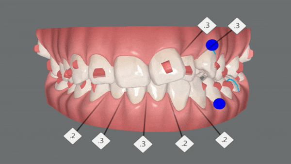 '웃을때 입을 자꾸 가려요'  활짝 웃은 중학생 비발치 인비절라인후기 (잠실새내인비절라인 청소년인비절라인 잠실교정치과) 관련 이미지 7