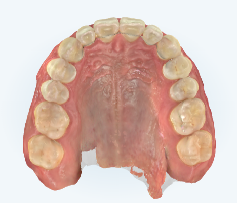 잠실덧니교정 인비절라인으로 컴플렉스 해결! (비발치교정 인비절라인등급 인비절라인후기 ) 관련 이미지 7