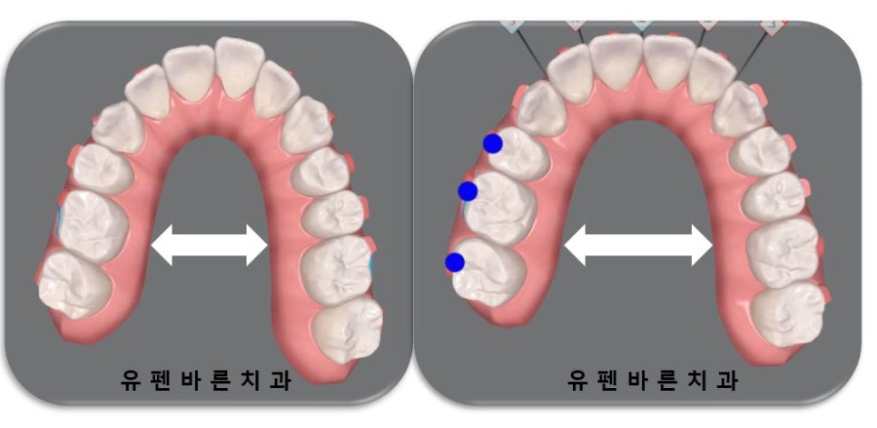 전세계 1400만명이 선택한 교정장치, 인비절라인 관련 이미지 3