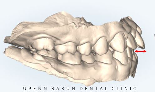 잠실청소년교정 청소년소년돌출입교정 잠실발치교정은 유펜바른치과에서! (잠실나루역교정치과 삼전역교정치과 잠실새내교정치과 돌출입전후 발치교정전후사진) 관련 이미지 7