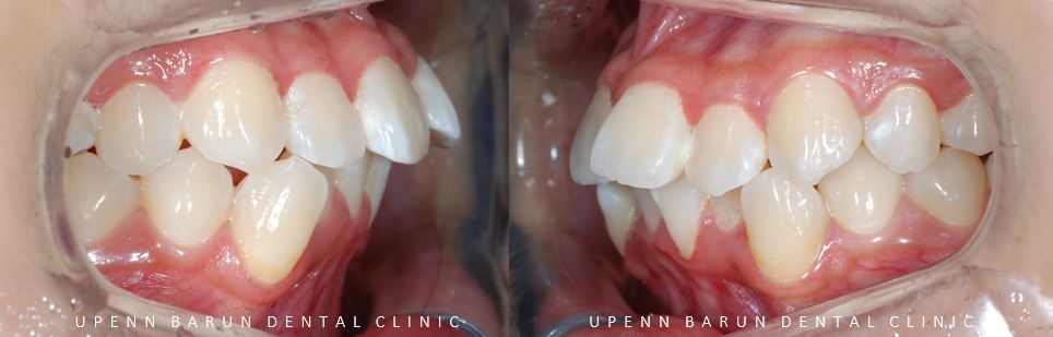 잠실돌출입교정 잠실발치교정 후기가 궁금하다면? (교정후얼굴변화후기 잠실교정치과 돌출입교정후기 돌출입전후사진) 관련 이미지 6