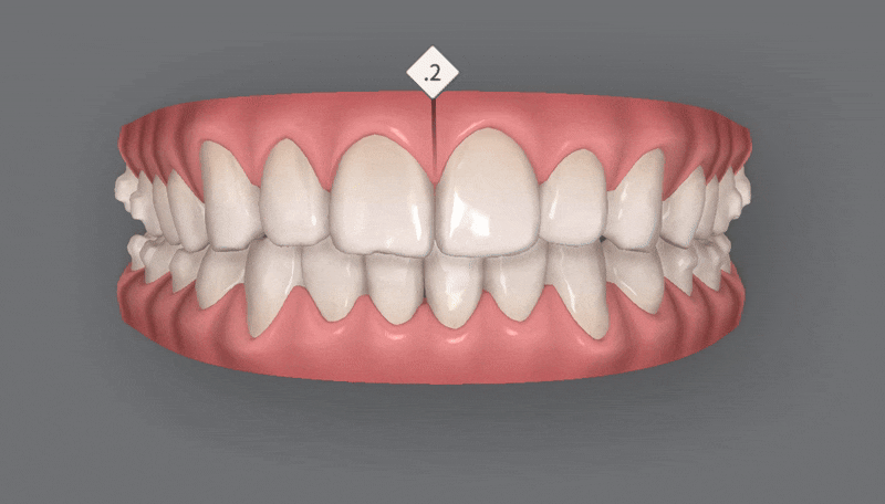 인비절라인을 시작할때 고려해야 하는 세가지 조건 (인비절라인다이아몬드 다이아몬드등급치과 인비절라인앞니교정 앞니급속교정 비발치교정 치간삭제 치간삭제양) 관련 이미지 12