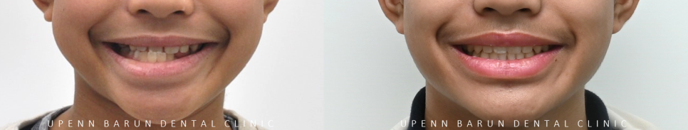 다이아몬드등급치과에서 인비절라인퍼스트로 반대교합 해결! 1차, 2차교정을 한번에!( 어린이반대교합 송파인비절라인퍼스트 잠실엘스상가교정치과 잠실인비절라인퍼스트 인비절라인스피커치과) 관련 이미지 22