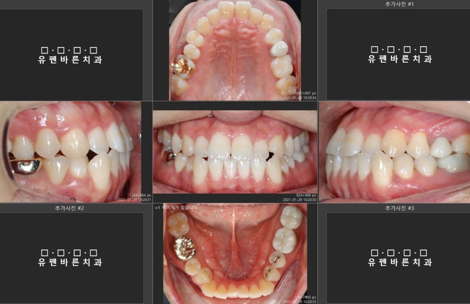 치과위생사의 인비절라인 첫 번째 이야기 관련 이미지 2