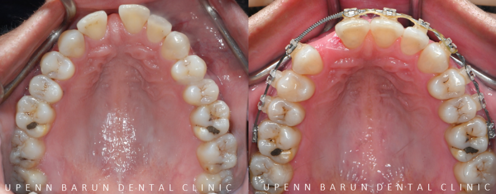 같은원장님께 보철치료와 교정치료를 동시에! 앞니사이 틈 해결한 후기 ( 송파교정치과 잠실교정잘하는치과 송파교정잘하는치과 올림픽파크포레온교정치과 올림픽파크포레온인비절라인치과) 관련 이미지 11