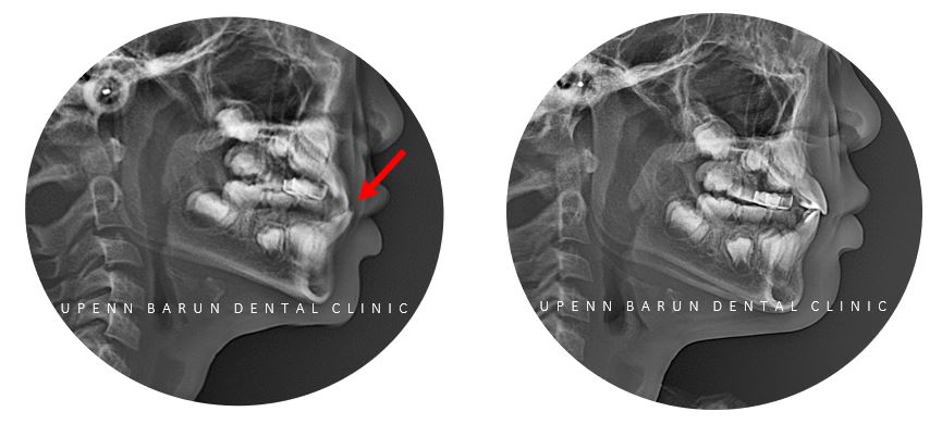8세 어린이반대교합 인비절라인퍼스트로 수월하게 해결 후기! 잠실인비절라인퍼스트 잠실인비절라인소아교정 (잠실교정치과 잠실인비절라인 인비절라인등급 인비절라인후기 잠실소아교정) 관련 이미지 7