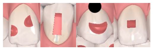 인비절라인을 시작할때 고려해야 하는 세가지 조건 (인비절라인다이아몬드 다이아몬드등급치과 인비절라인앞니교정 앞니급속교정 비발치교정 치간삭제 치간삭제양) 관련 이미지 11