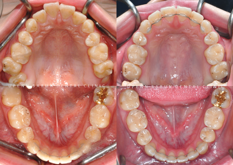 반대교합+개방교합 비수술교정 유펜바른치과에서 재교정한 후기! ( 비발치개방교합 비발치반대교합 재교정후기 잠실교정치과 미니스크류비수술교정 악궁확장장치 MARPE) 관련 이미지 8