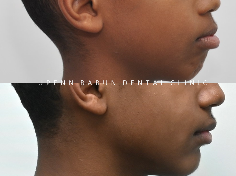 성장기에 돌출입이 고민이라면? 돌출입청소년교정 입술무력증 해결도 유펜바른치과에서! (잠실청소년교정 잠실돌출입교정 돌출입교정기간 발치교정외모변화 외국인교정치과) 관련 이미지 10