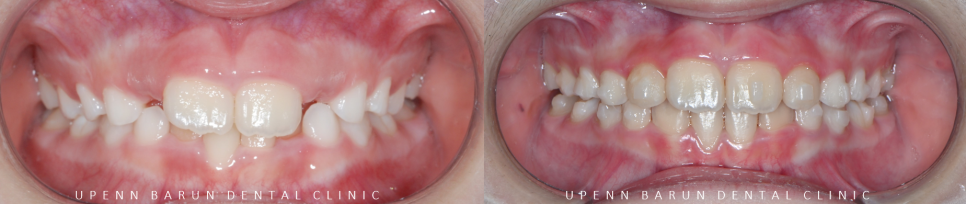 송파인비절라인퍼스트 인비절라인어린이교정 11개월만에 끝낸 후기(잠실인비절라인 잠실파인애플상가교정치과 인비절라인소아교정후기 인비절라인플래티넘엘리트등급) 관련 이미지 9