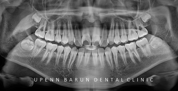 비발치교정 성장기교정 청소년치아교정은 잠실교정치과 유펜바른치과에서 관련 이미지 8
