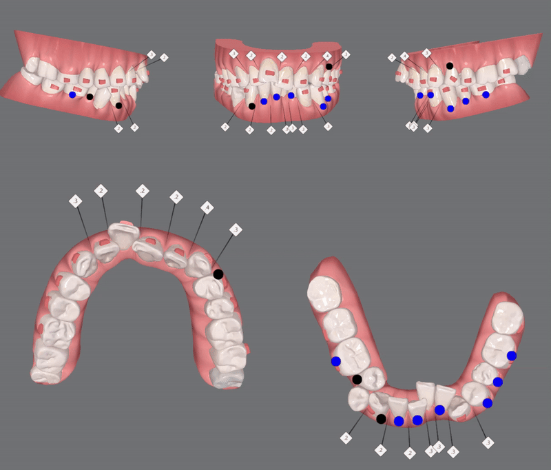 평생 삐뚤어진 치아가 고민이셨던 79세 고령환자분이 선택한 송파인비절라인다이아몬드등급 후기 (서울인비절라인전문치과 잠실인비절라인교정치과 노인교정 노인치아교정 노인교정치과) 관련 이미지 9