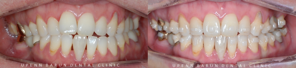 인비절라인 공식 스피커가 상주하고 치료하는 송파교정잘하는치과 유펜바른치과 (잠실성인교정 잠실재교정 잠실인비절라인 성인인비절라인교정 잠실나루역교정치과 문정동교정치과 삼전역교정치과) 관련 이미지 11