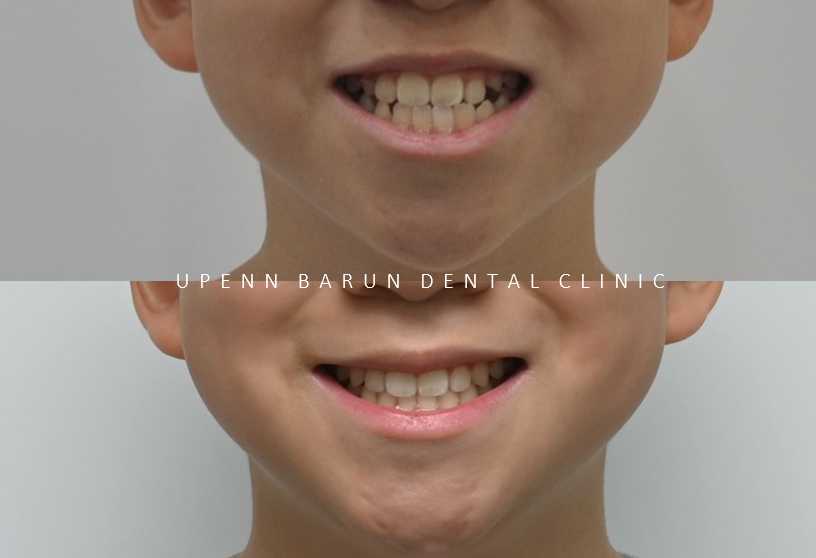 송파인비절라인다이아몬드등급치과 에서 인비절라인으로 1차 2차 교정을 한번에! (송파인비절라인퍼스트 잠실어린이인비절라인 인비절라인소아교정 잠실소아교정 어린이반대교합) 관련 이미지 4