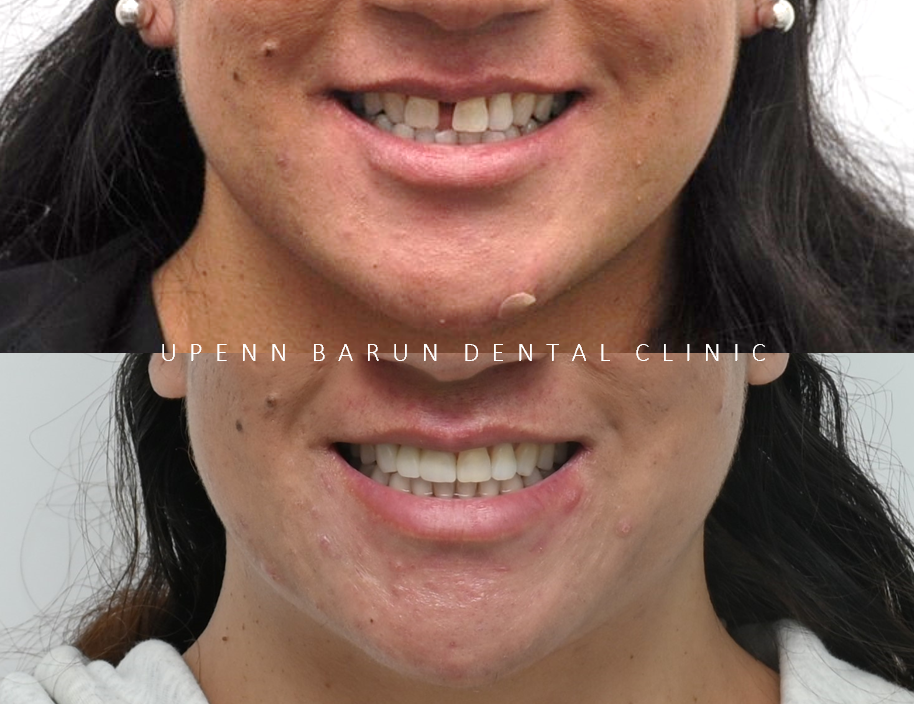 같은원장님께 보철치료와 교정치료를 동시에! 앞니사이 틈 해결한 후기 ( 송파교정치과 잠실교정잘하는치과 송파교정잘하는치과 올림픽파크포레온교정치과 올림픽파크포레온인비절라인치과) 관련 이미지 2