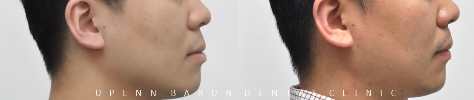 잠실덧니교정 인비절라인으로 컴플렉스 해결! (비발치교정 인비절라인등급 인비절라인후기 ) 관련 이미지 13