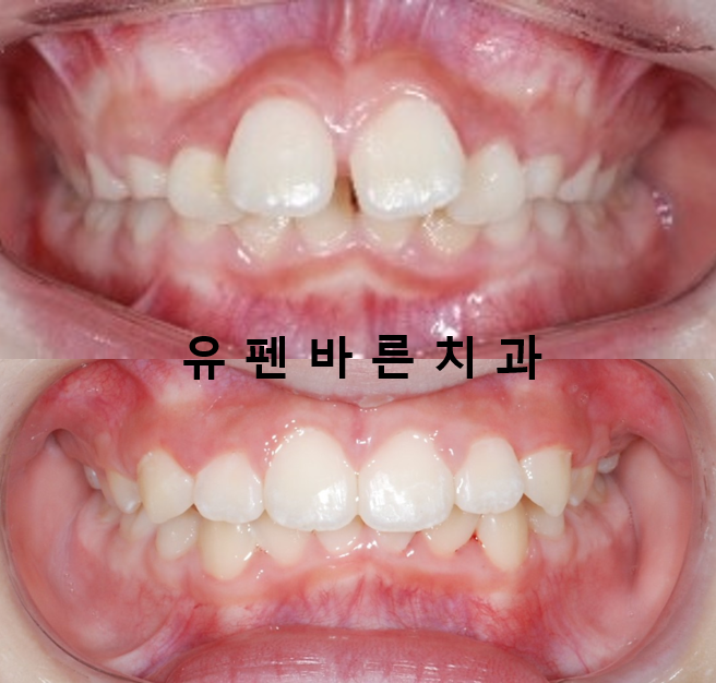 우리아이, 무턱교정 해야할까요? 관련 이미지 5