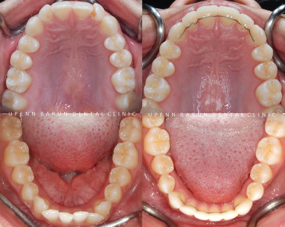 비발치 세라믹교정 후기 (앞니교정 잠실부분교정 잠실교정치과 잠실새내교정치과) 관련 이미지 8