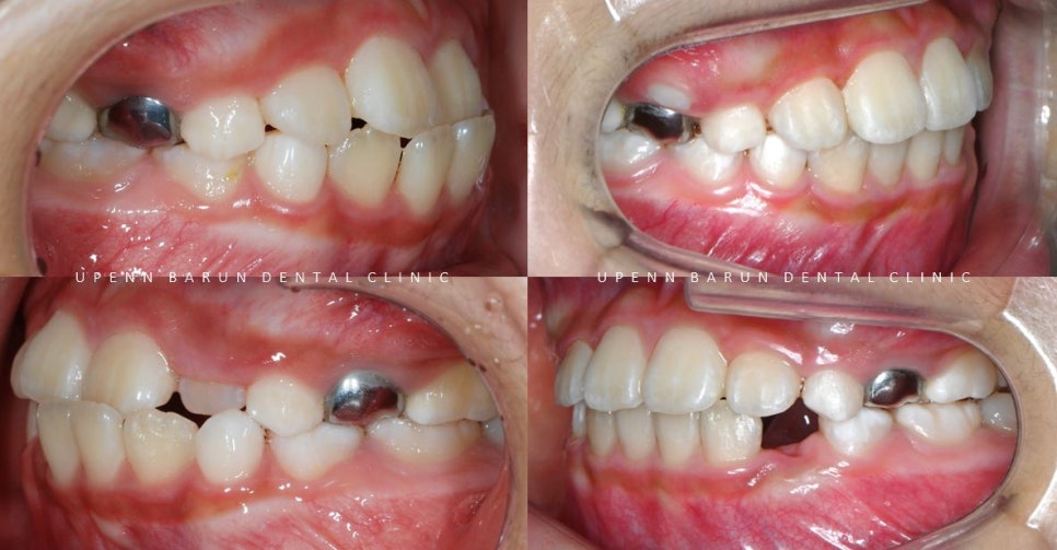 8세 어린이반대교합 인비절라인퍼스트로 수월하게 해결 후기! 잠실인비절라인퍼스트 잠실인비절라인소아교정 (잠실교정치과 잠실인비절라인 인비절라인등급 인비절라인후기 잠실소아교정) 관련 이미지 8