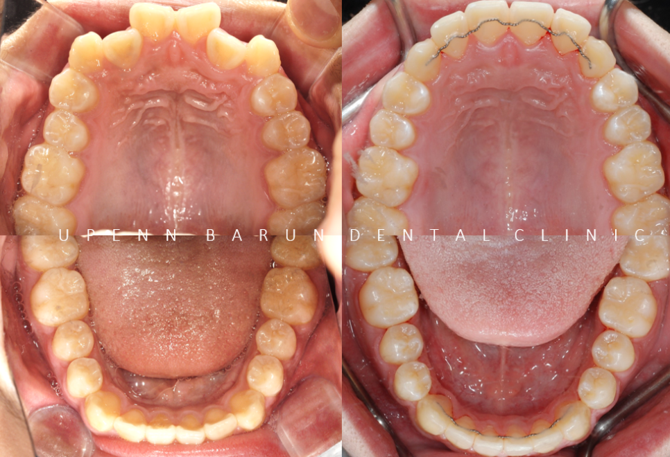 비발치교정 성장기교정 청소년치아교정은 잠실교정치과 유펜바른치과에서 관련 이미지 7