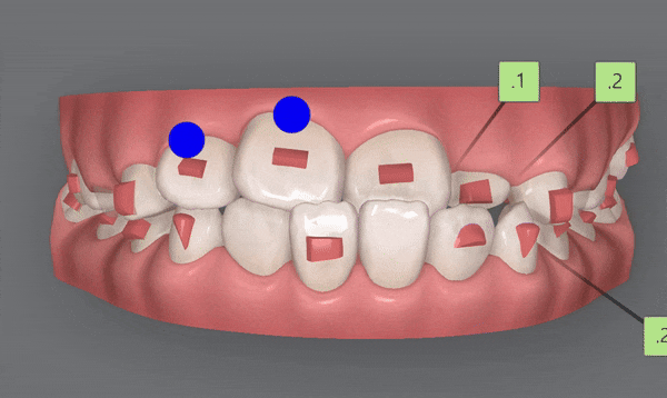 8세 어린이반대교합 인비절라인퍼스트로 수월하게 해결 후기! 잠실인비절라인퍼스트 잠실인비절라인소아교정 (잠실교정치과 잠실인비절라인 인비절라인등급 인비절라인후기 잠실소아교정) 관련 이미지 9