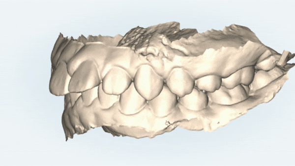 잠실새내역청소년교정 잠실돌출입발치교정은 유펜바른치과!(잠실중학생발치교정 잠실무턱교정 잠실새내소아교정치과 잠실새내교정잘하는치과 발치교정외모변화) 관련 이미지 3