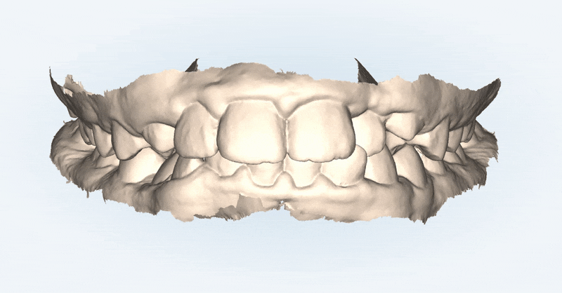 성장기에 돌출입이 고민이라면? 돌출입청소년교정 입술무력증 해결도 유펜바른치과에서! (잠실청소년교정 잠실돌출입교정 돌출입교정기간 발치교정외모변화 외국인교정치과) 관련 이미지 3