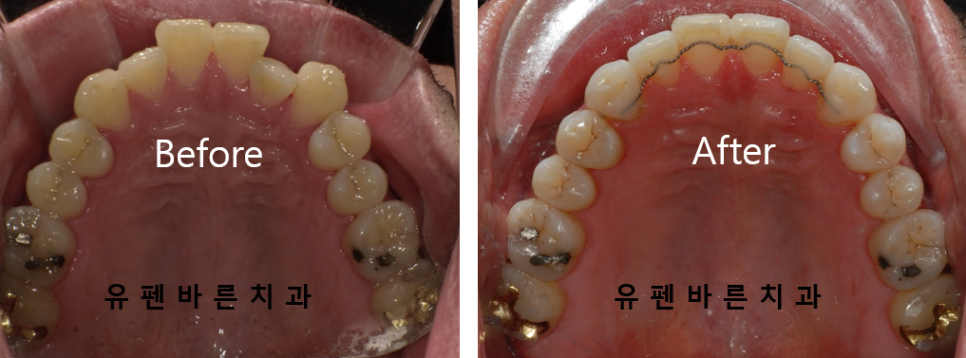 나스닥에 상장한 인비절라인, 잠실투명교정 잠실인비절라인 후기와 치아미백이 궁금하다면? 관련 이미지 15