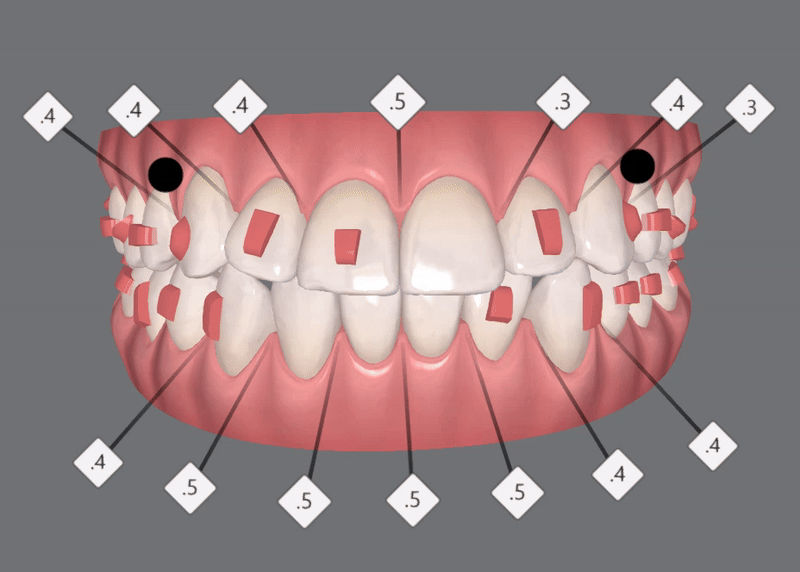 "치아가 앞으로 뻐드러졌어요!" 송파인비절라인다이아몬드등급치과에서!!(비발치인비절라인 뻐드렁니교정치과 돌출입교정치과) 관련 이미지 8