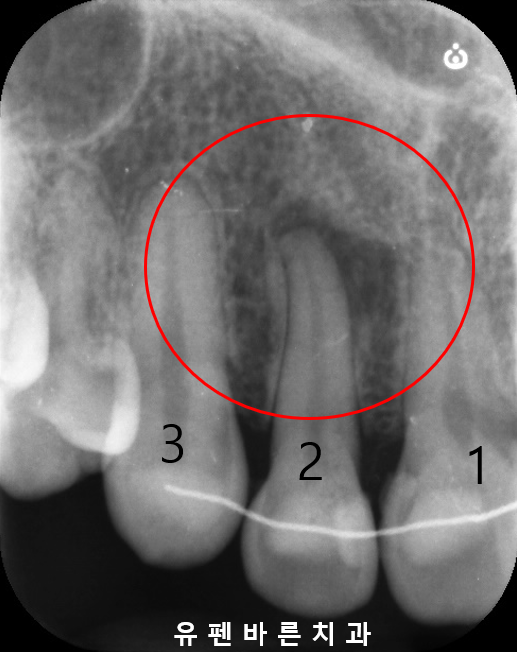 예전에 교정했는데 앞니가 뻐드러져서 컴플렉스에요! ( 비발치교정 인비절라인으로 재교정 해볼까요?) 관련 이미지 5