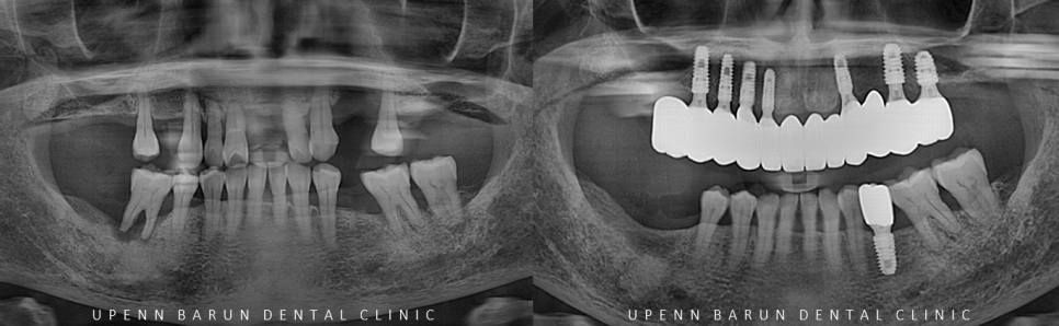 잠실새내역임플란트 잠실새내역치과 유펜바른치과에서 전체임플란트치료 ( 잠실임플란트후기 임플란트기간  전체임플란트) 관련 이미지 10