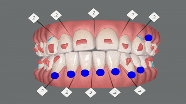 개방교합은 교정용 미니스크류 쓰지말고 인비절라인만으로 쉽게 해결하세요! (잠실인비절라인  잠실새내인비절라인  개방교합교정  잠실새내교정치과) 관련 이미지 9