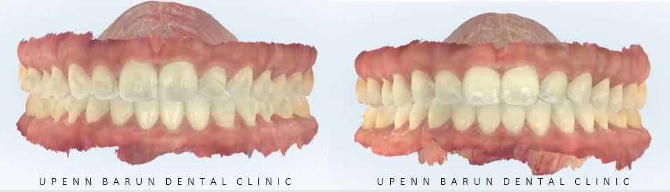 앞니벌어짐 인비절라인익스프레스로 해결하기 (인비절라인앞니부분교정 인비절라인재교정 송파인비절라인 잠실인비절라인 잠실교정치과 인비절라인익스프레스비용) 관련 이미지 11