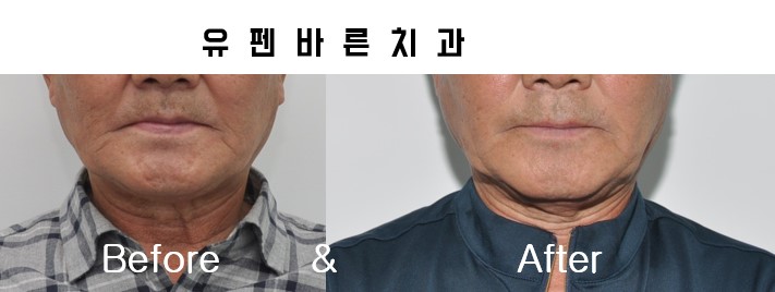 해보니까 임플란트가 편해요!!! 관련 이미지 7