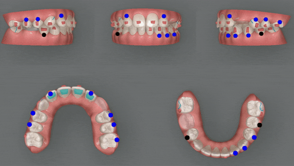 잠실소아인비절라인 잠실어린이인비절라인 송파인비절라인 잠실인비절라인후기 (잠실새내교정치과 엘스상가교정치과 파인애플상가교정치과 잠실새내역인비절라인 청소년교정후기 잠실인비절라인퍼스트) 관련 이미지 9