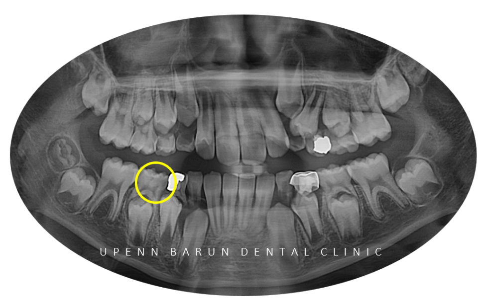 잠실소아인비절라인 잠실어린이인비절라인 송파인비절라인 잠실인비절라인후기 (잠실새내교정치과 엘스상가교정치과 파인애플상가교정치과 잠실새내역인비절라인 청소년교정후기 잠실인비절라인퍼스트) 관련 이미지 6