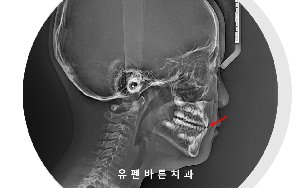 아이가 반대교합(주걱턱)인데 1차교정을 꼭해야 하나요? 관련 이미지 4