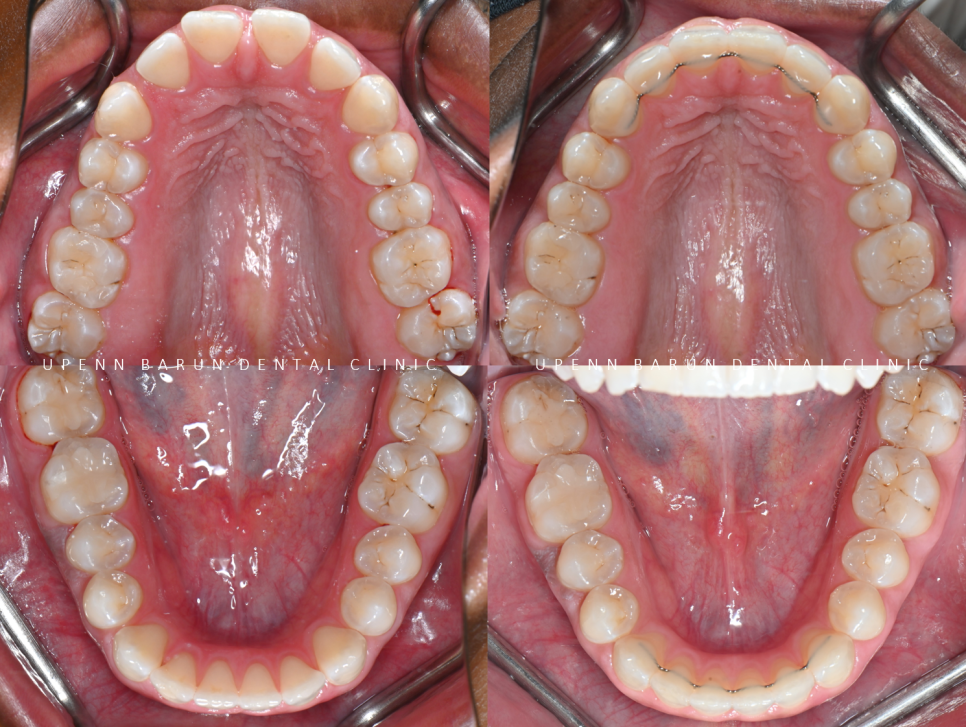 잠실인비절라인등급 잠실부분교정 앞니틈교정 인비절라인라이트 옵션으로 빠르게 해결한 후기 (삼성역부분교정 인비절라인앞니재교정 잠실역교정치과 삼전동인비절라인 삼전동교정치과) 관련 이미지 17