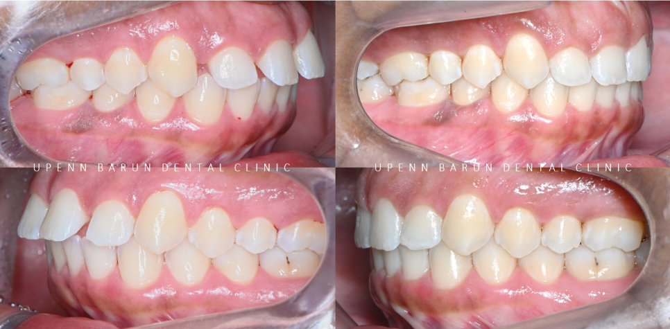 잠실인비절라인등급 잠실부분교정 앞니틈교정 인비절라인라이트 옵션으로 빠르게 해결한 후기 (삼성역부분교정 인비절라인앞니재교정 잠실역교정치과 삼전동인비절라인 삼전동교정치과) 관련 이미지 16