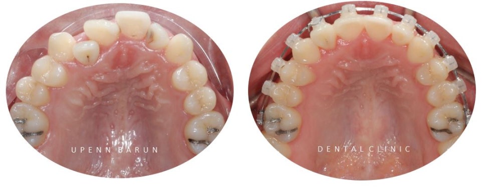잠실데이몬교정, 비발치교정, 잠실덧니교정 (AKA Damon Smile) 관련 이미지 5