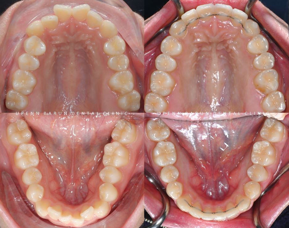 유학생치아교정 유학생교정치과 잠실교정치과 잠실데이몬교정 데이몬클리어교정 Wide Smile (송파교정치과 잠실새내교정치과 강동교정치과 헬리오시티교정치과 예쁜미소 Smile Arc) 관련 이미지 6